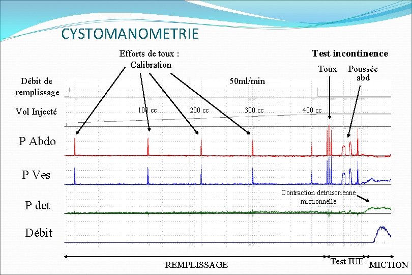 CYSTOMANOMETRIE Test incontinence Efforts de toux : Calibration Toux Débit de remplissage Vol Injecté