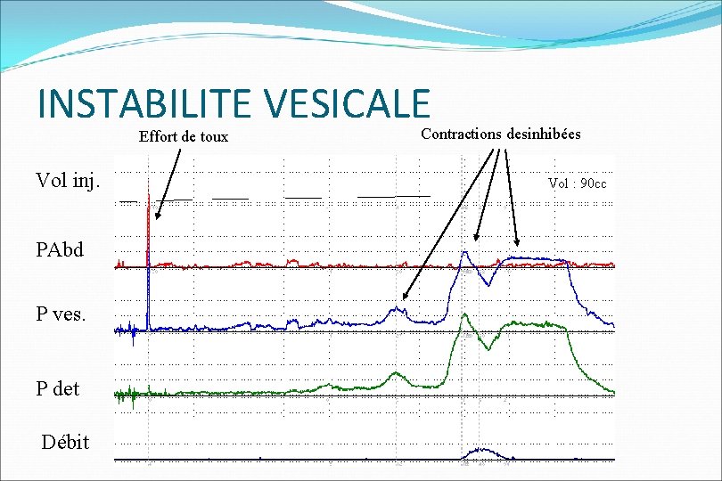 INSTABILITE VESICALE Effort de toux Vol inj. PAbd P ves. P det Débit Contractions