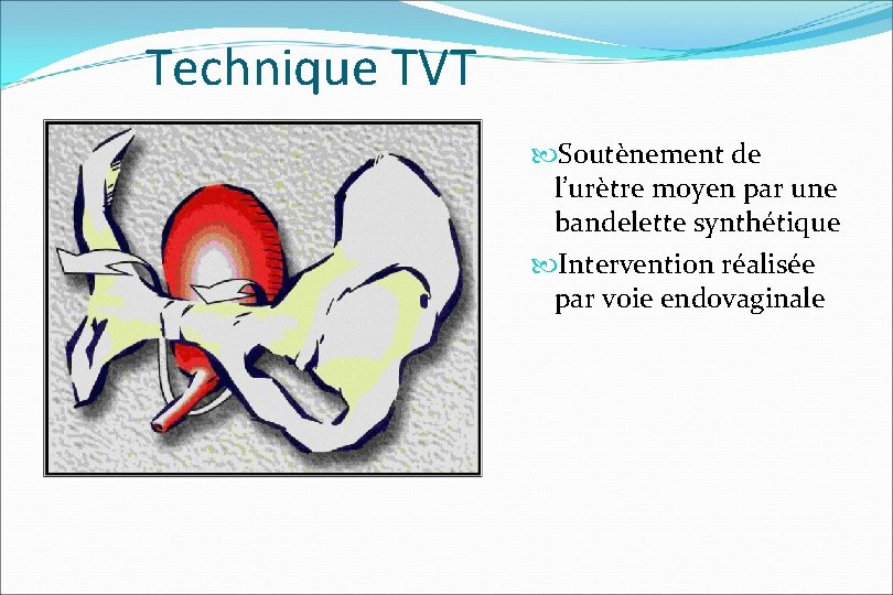 Technique TVT Soutènement de l’urètre moyen par une bandelette synthétique Intervention réalisée par voie