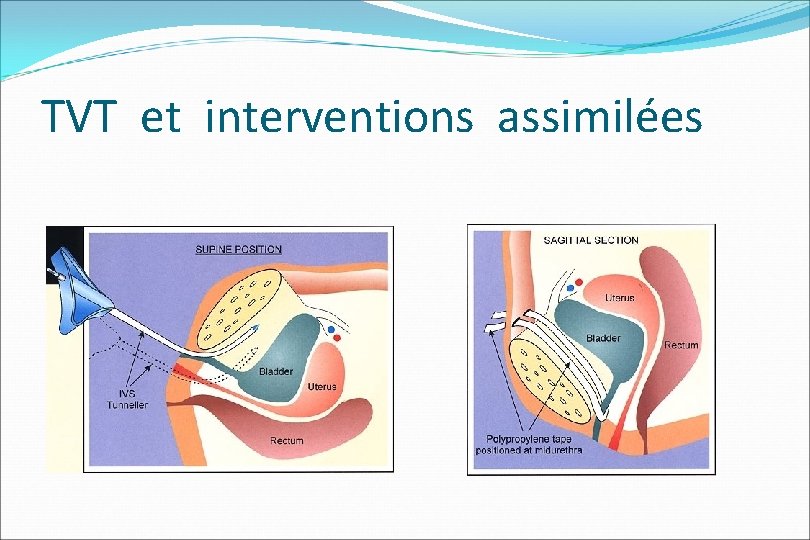 TVT et interventions assimilées 