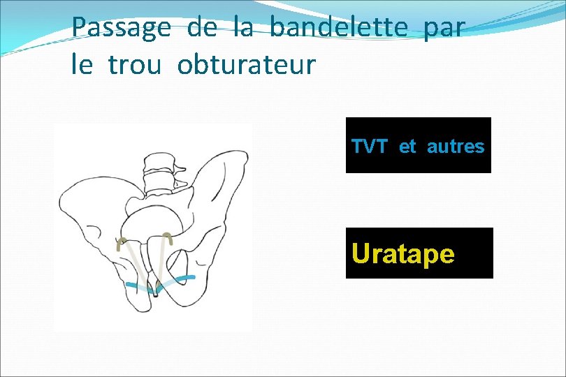 Passage de la bandelette par le trou obturateur TVT et autres Uratape 