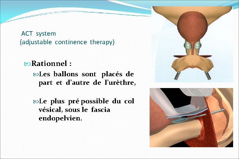 ACT system (adjustable continence therapy) Rationnel : Les ballons sont placés de part et