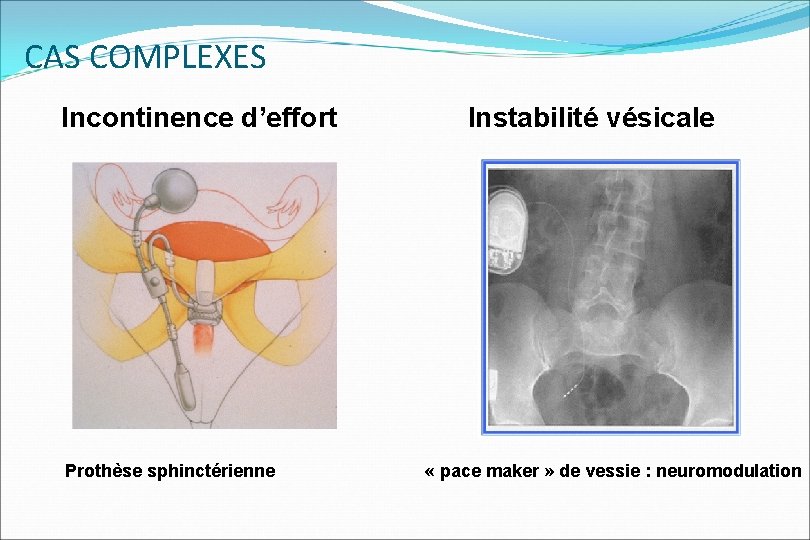 CAS COMPLEXES Incontinence d’effort Instabilité vésicale Prothèse sphinctérienne « pace maker » de vessie