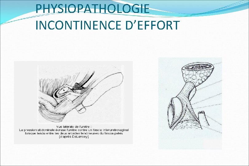 PHYSIOPATHOLOGIE INCONTINENCE D’EFFORT 