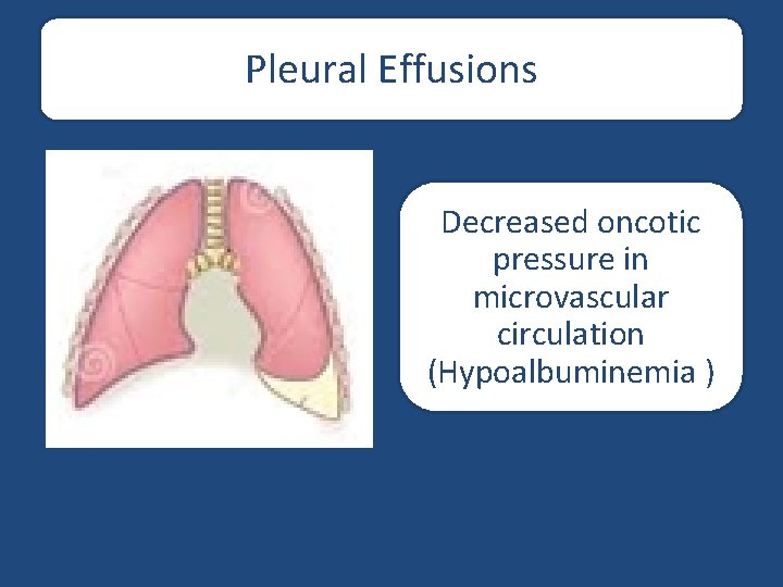 Pleural Effusions Decreased oncotic pressure in microvascular circulation (Hypoalbuminemia ) 