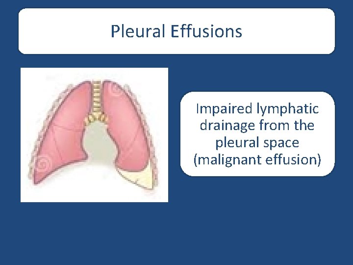 Pleural Effusions Impaired lymphatic drainage from the pleural space (malignant effusion) 