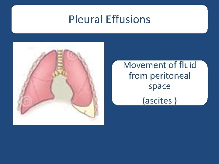 Pleural Effusions Movement of fluid from peritoneal space (ascites ) 