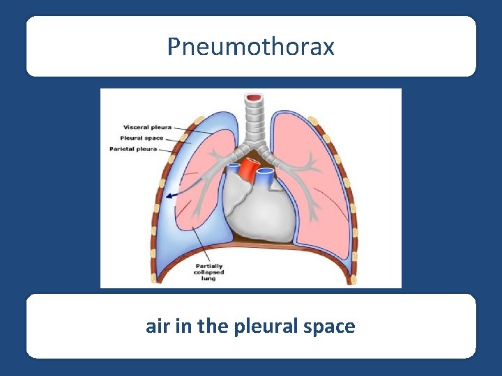 Pneumothorax air in the pleural space 