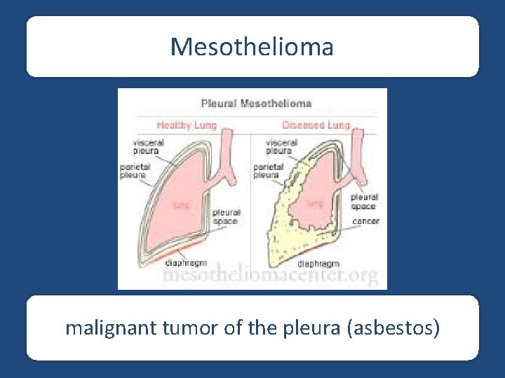 Mesothelioma malignant tumor of the pleura (asbestos) 