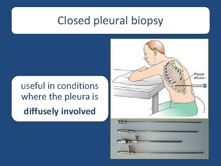 Closed pleural biopsy useful in conditions where the pleura is diffusely involved 