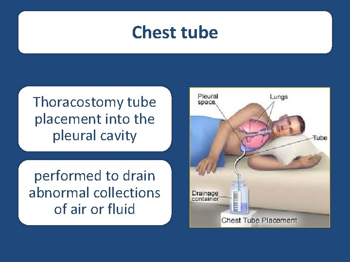 Chest tube Thoracostomy tube placement into the pleural cavity performed to drain abnormal collections