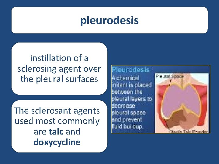 pleurodesis instillation of a sclerosing agent over the pleural surfaces The sclerosant agents used