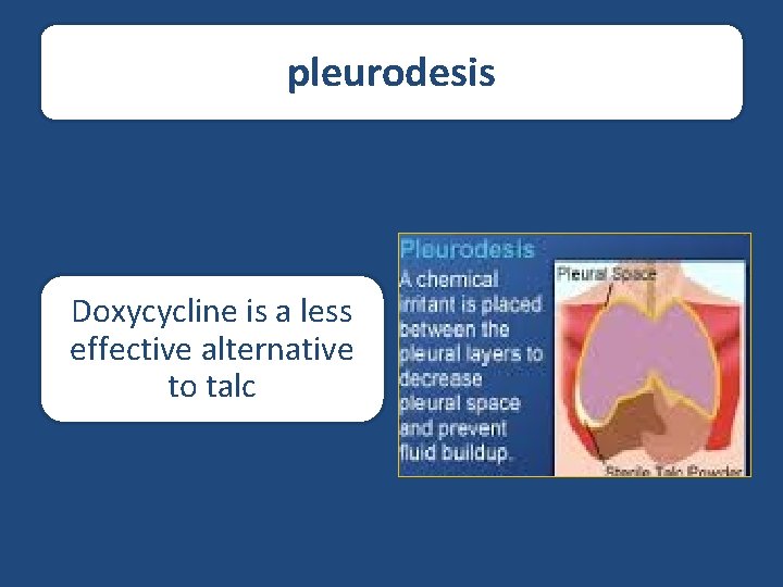 pleurodesis Doxycycline is a less effective alternative to talc 