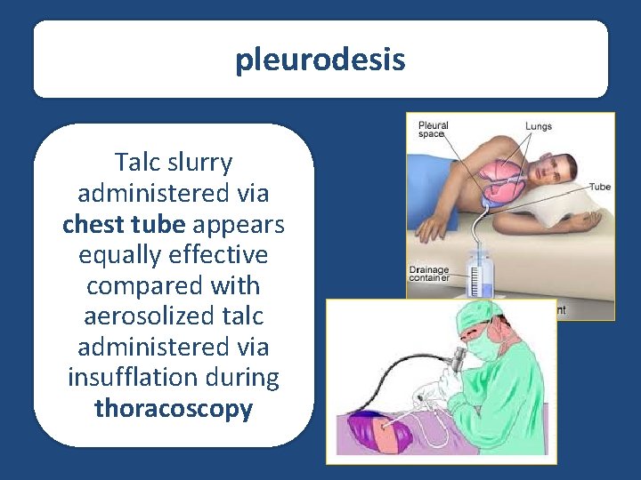 pleurodesis Talc slurry administered via chest tube appears equally effective compared with aerosolized talc