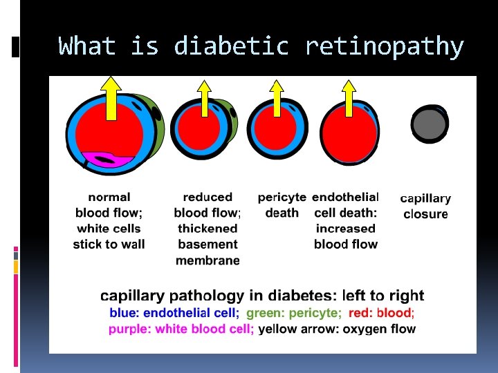 What is diabetic retinopathy 