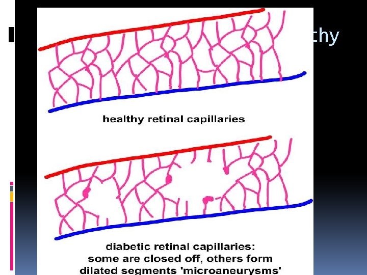 What is diabetic retinopathy 