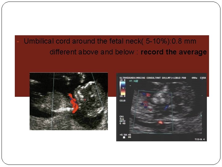 - Umbilical cord around the fetal neck( 5 -10%): 0. 8 mm different above