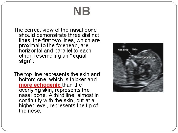 NB The correct view of the nasal bone should demonstrate three distinct lines: the