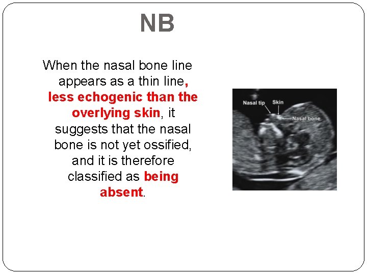 NB When the nasal bone line appears as a thin line, less echogenic than