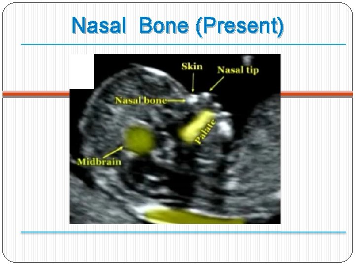 Nasal Bone (Present) 