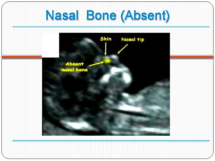 Nasal Bone (Absent) 