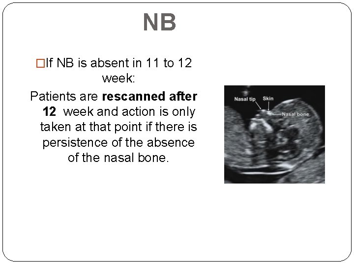 NB �If NB is absent in 11 to 12 week: Patients are rescanned after