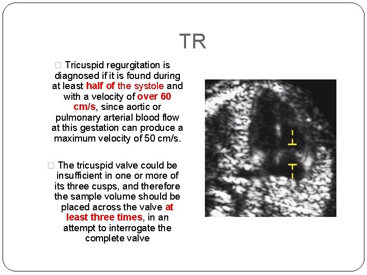 TR � Tricuspid regurgitation is diagnosed if it is found during at least half