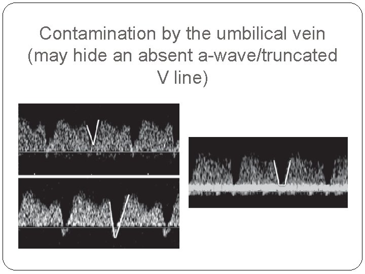Contamination by the umbilical vein (may hide an absent a-wave/truncated V line) 