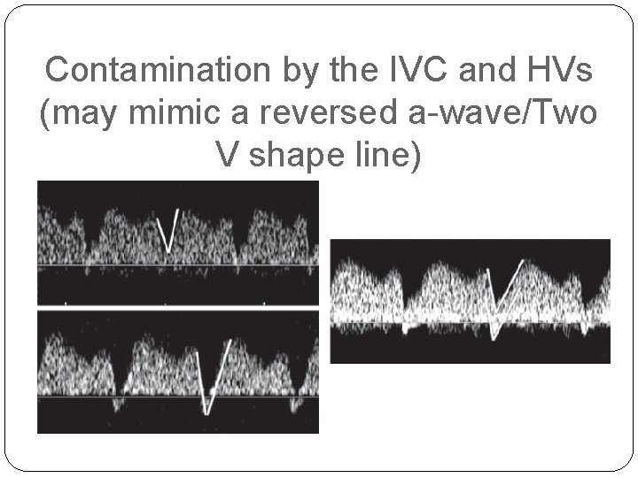 Contamination by the IVC and HVs (may mimic a reversed a-wave/Two V shape line)