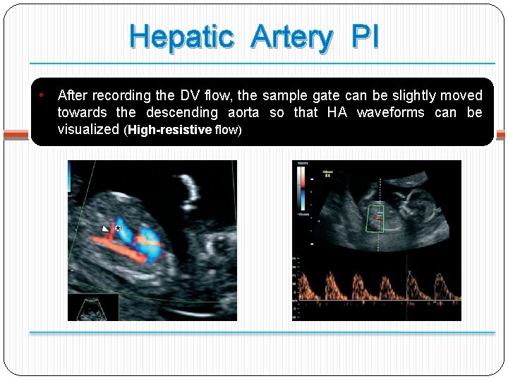 Hepatic Artery PI • After recording the DV flow, the sample gate can be