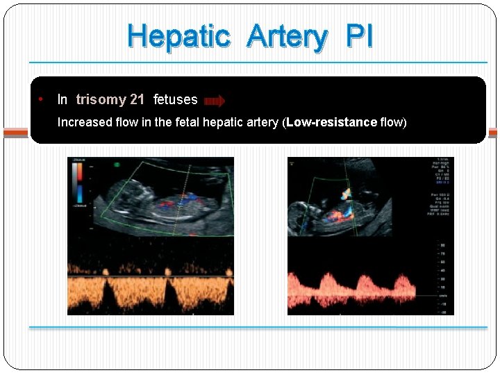 Hepatic Artery PI • In trisomy 21 fetuses Increased ﬂow in the fetal hepatic