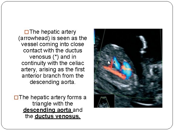 � The hepatic artery (arrowhead) is seen as the vessel coming into close contact