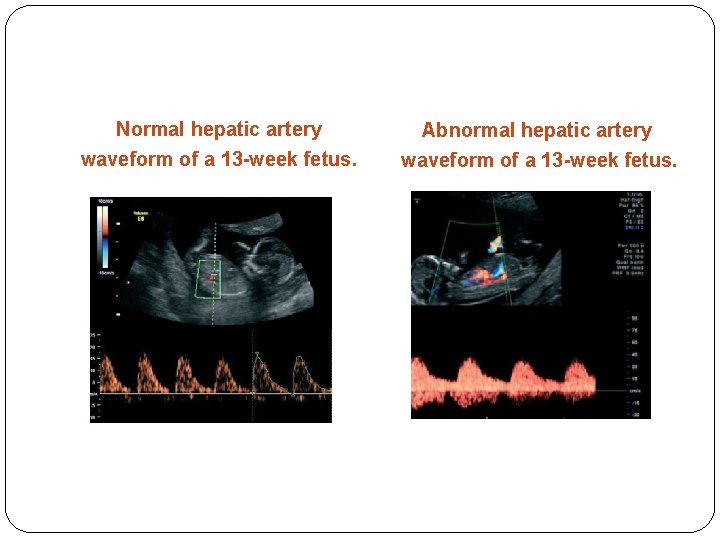 Normal hepatic artery waveform of a 13 -week fetus. Abnormal hepatic artery waveform of