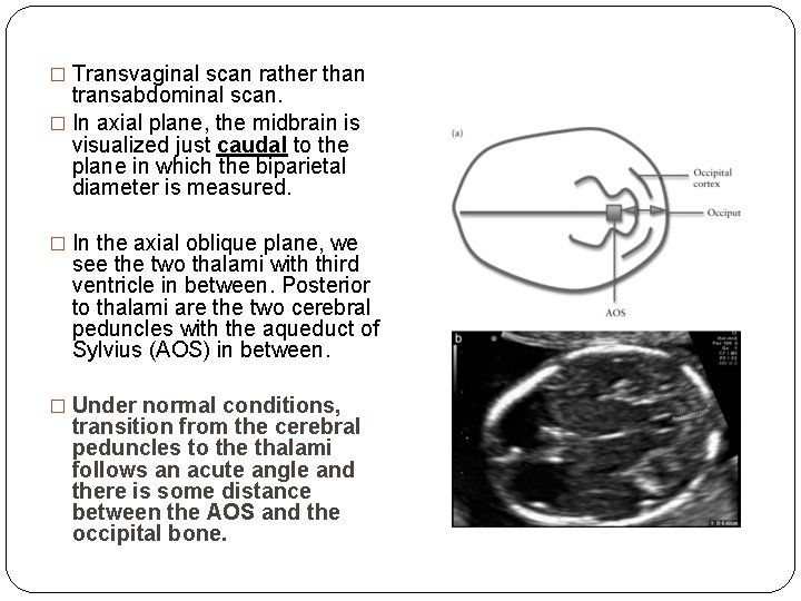 � Transvaginal scan rather than transabdominal scan. � In axial plane, the midbrain is