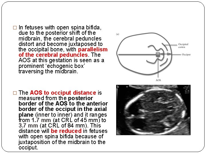 � In fetuses with open spina bifida, due to the posterior shift of the