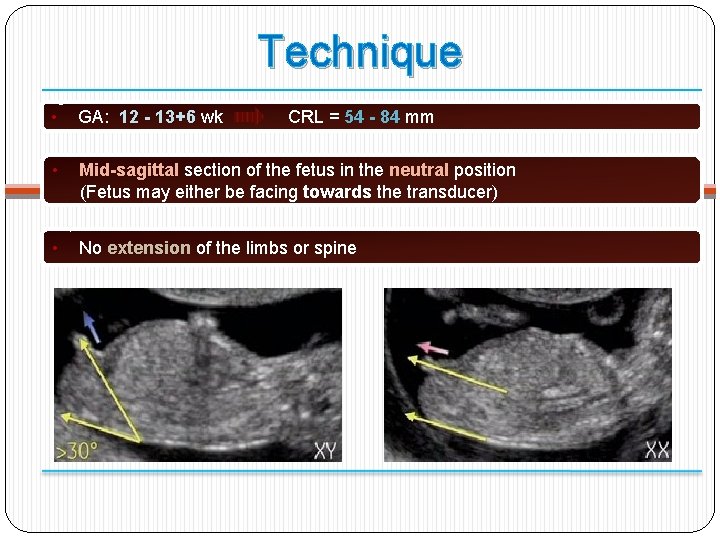 Technique • GA: 12 - 13+6 wk • Mid-sagittal section of the fetus in