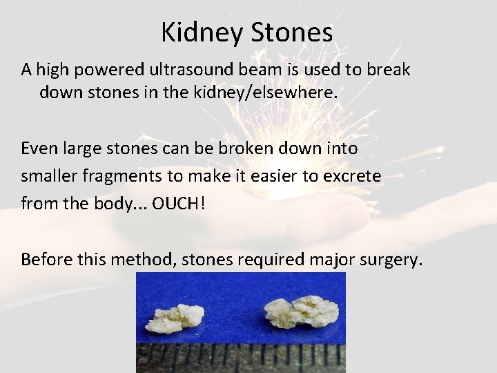 Kidney Stones A high powered ultrasound beam is used to break down stones in