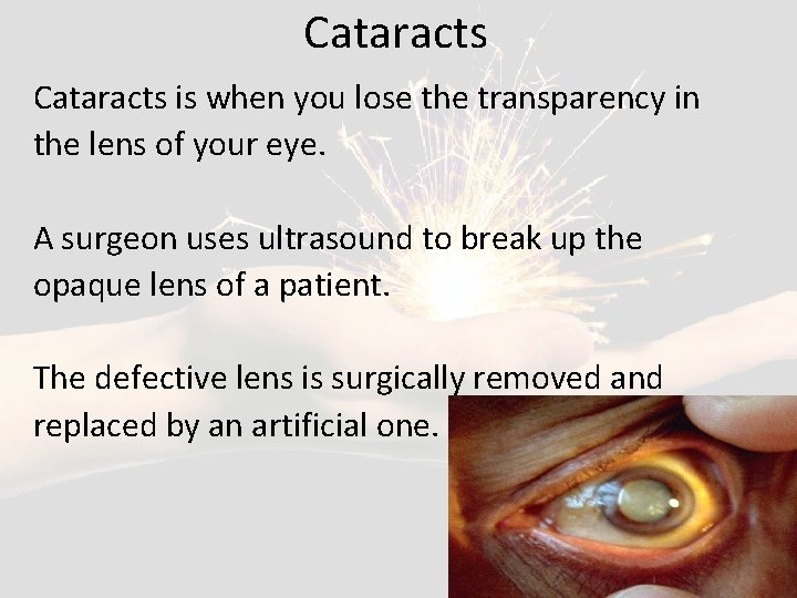 Cataracts is when you lose the transparency in the lens of your eye. A