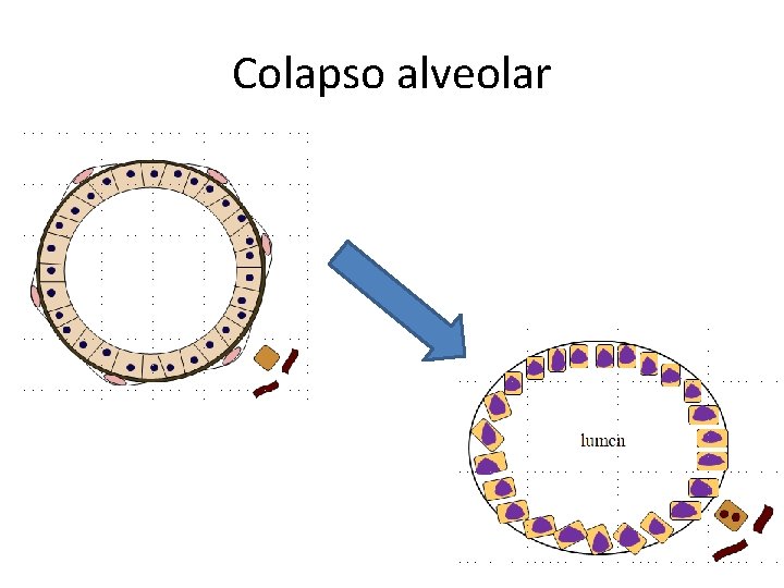 Colapso alveolar 