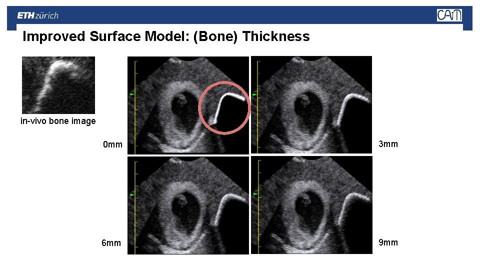 Improved Surface Model: (Bone) Thickness in-vivo bone image 0 mm 3 mm 6 mm