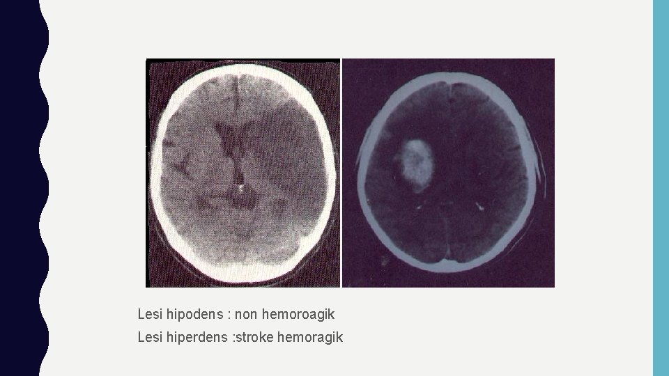 Lesi hipodens : non hemoroagik Lesi hiperdens : stroke hemoragik 