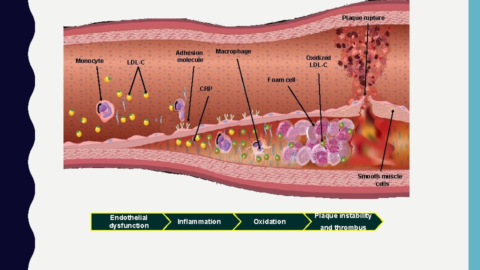 Plaque rupture Monocyte LDL-C Adhesion molecule Macrophage Oxidized LDL-C Foam cell CRP Smooth muscle