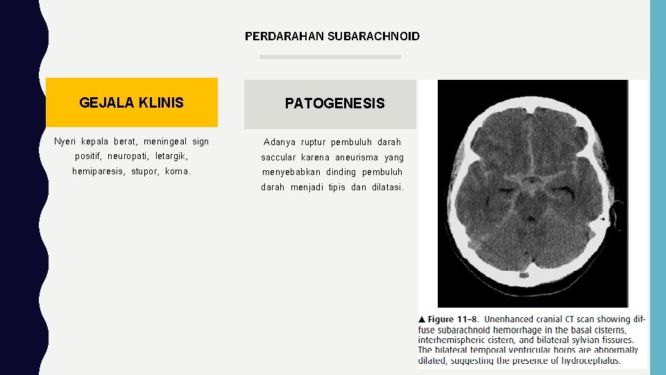 PERDARAHAN SUBARACHNOID GEJALA KLINIS PATOGENESIS Nyeri kepala berat, meningeal sign positif, neuropati, letargik, hemiparesis,