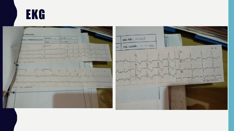 EKG 