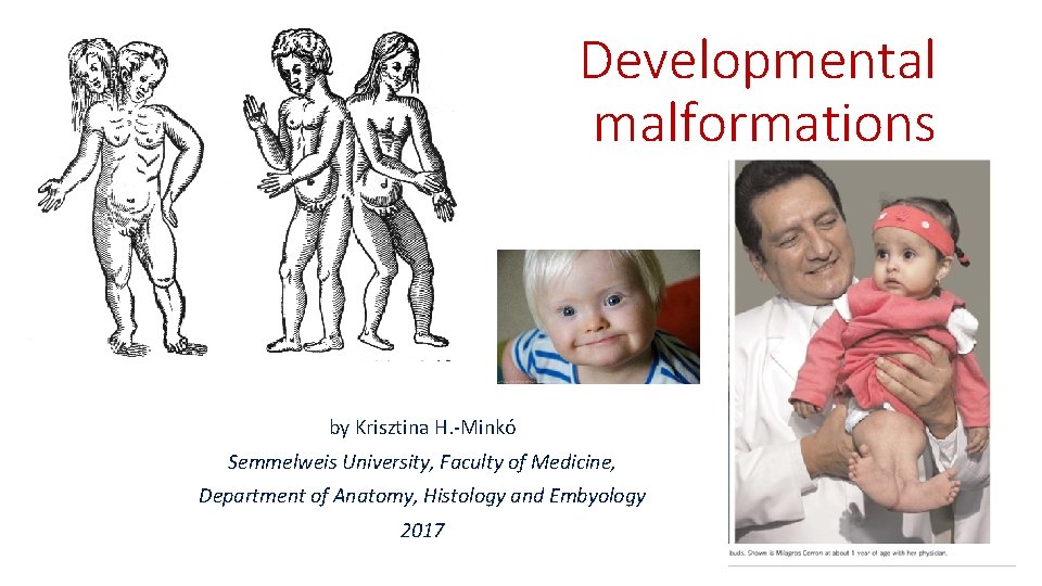 Developmental malformations by Krisztina H. -Minkó Semmelweis University, Faculty of Medicine, Department of Anatomy,