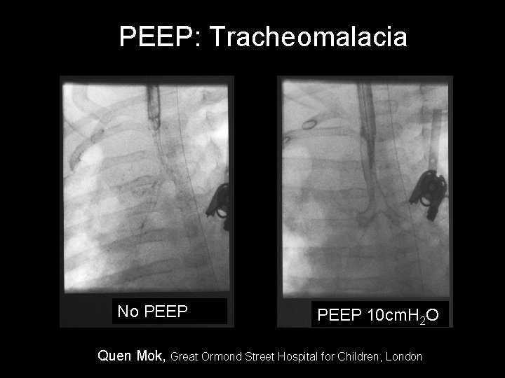 PEEP: Tracheomalacia No PEEP 10 cm. H 2 O Quen Mok, Great Ormond Street PEEP: Tracheomalacia No PEEP 10 cm. H 2 O Quen Mok, Great Ormond Street