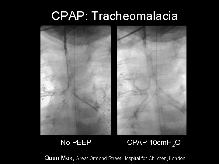 CPAP: Tracheomalacia No PEEP CPAP 10 cm. H 2 O Quen Mok, Great Ormond CPAP: Tracheomalacia No PEEP CPAP 10 cm. H 2 O Quen Mok, Great Ormond