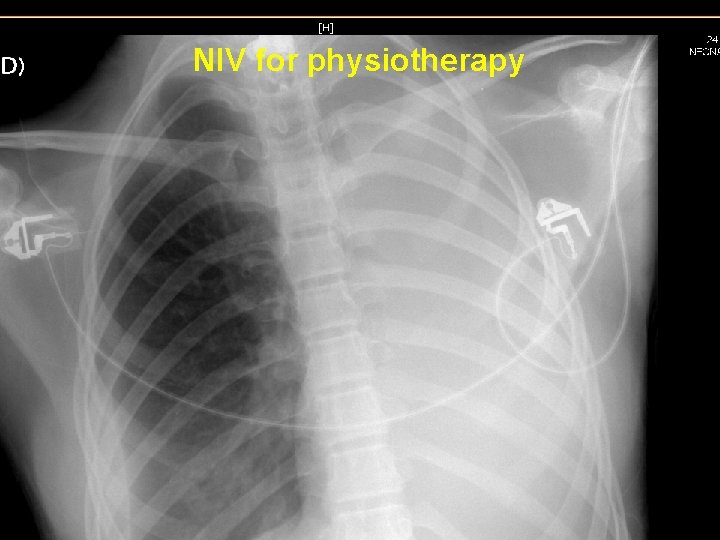 NIV for physiotherapy NIV for physiotherapy