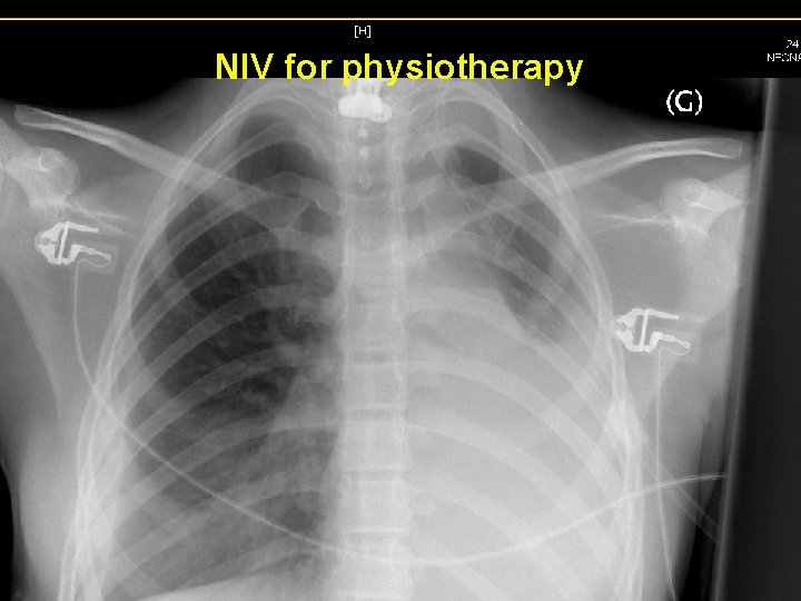 NIV for physiotherapy NIV for physiotherapy