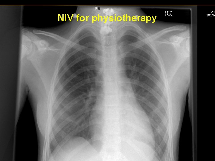 NIV for physiotherapy NIV for physiotherapy